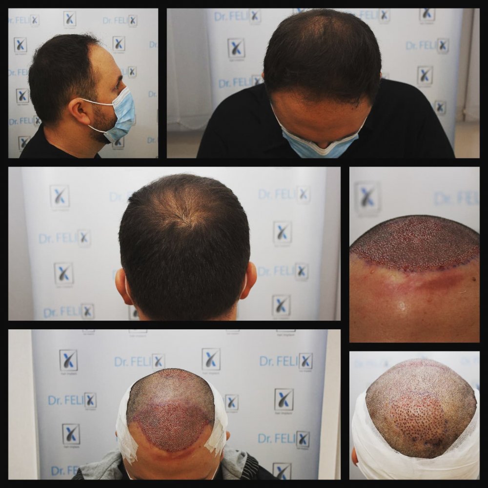 Dr. Felix, solutia pentru tine in ceea ce priveste alopecia