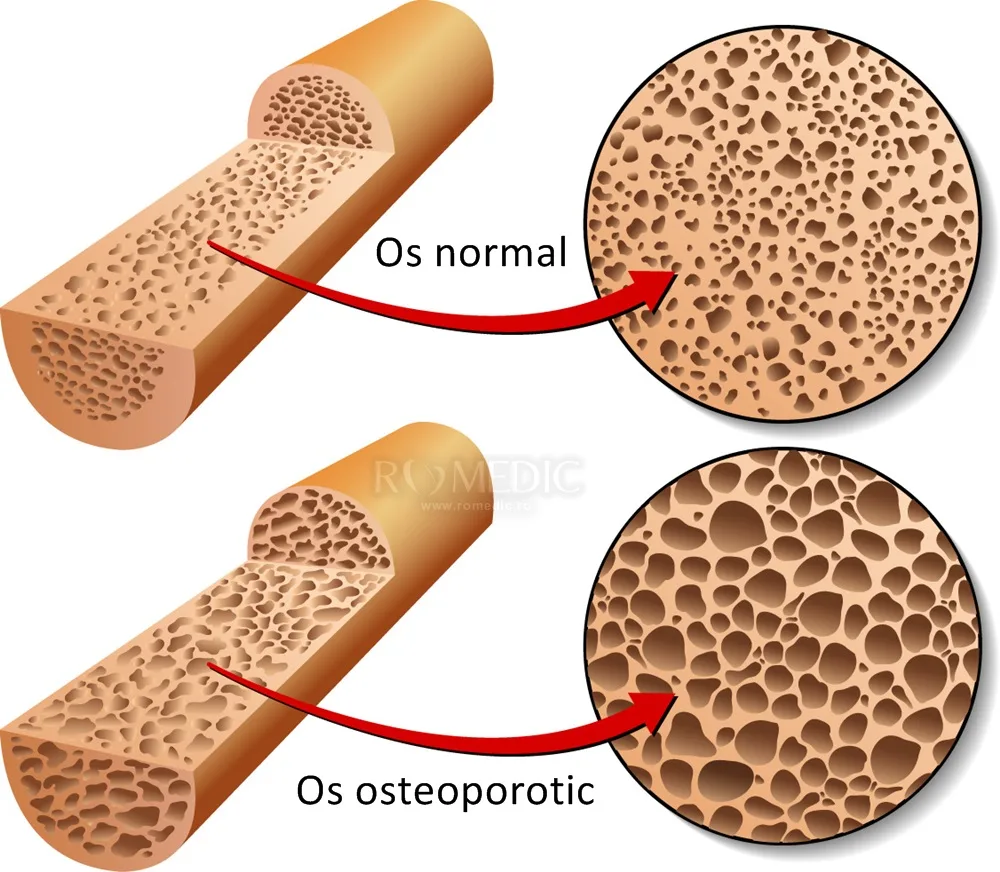 Cauzele osteoporozei, boala care afectează 1 milion de români