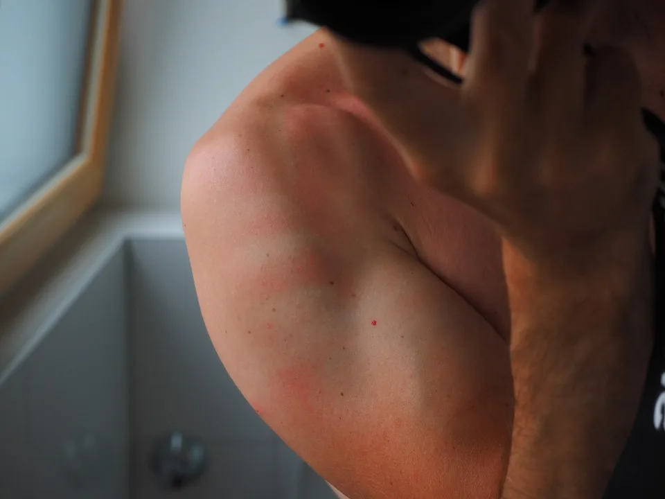 5 remedii naturale pentru pielea iritata