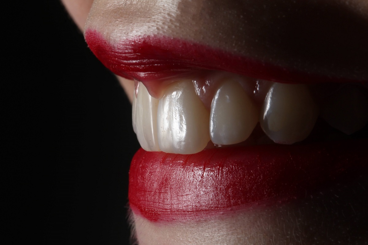 Ce să alegi între albirea dinților și fațetele dentare?