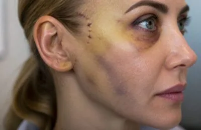 Iulia Albu a arătat recuperarea după un deep plane facelift și a spus că a avut 2 zile dificile